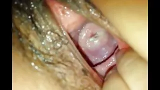 পায়ে কালো কেশিক দুশ ...